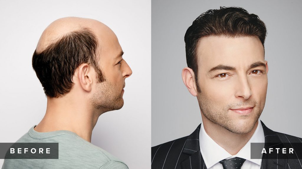 mens before and after gallery hrs of portland
